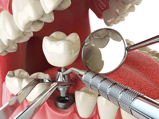 Best Urgent Care for Lost Fillings or Crowns in Fannett, TX