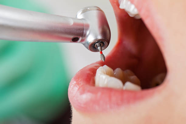 Best Emergency Treatment for Dental Infections or Abscesses in Fannett, TX